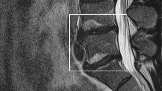 Pin Modic What are Modic changes? | Intracept™ patient website