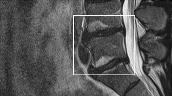 MRI scan highlighting vertebral endplates.