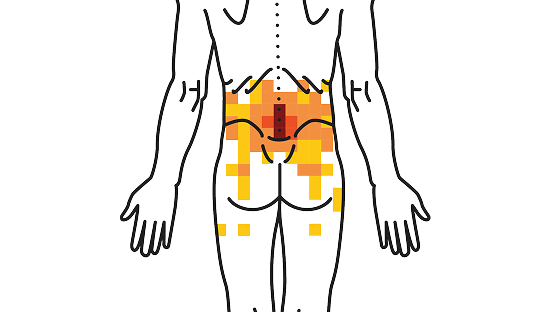 Diagram highlighting back regions affected by vertebrogenic pain.
